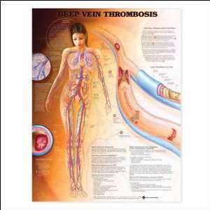  Deep Vein Thrombosis Anatomical Chart 20 X 26 Laminated 
