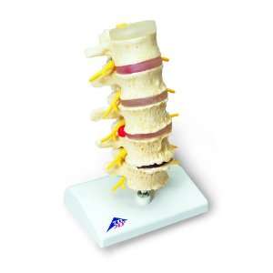   Stages of Disc Prolapse and Vertebral Degeneration Model, 8.7 Height