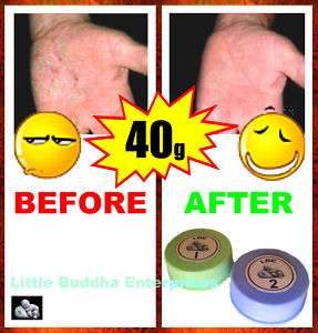 Get rid of Eczema / Dermatitis once and forever ***  